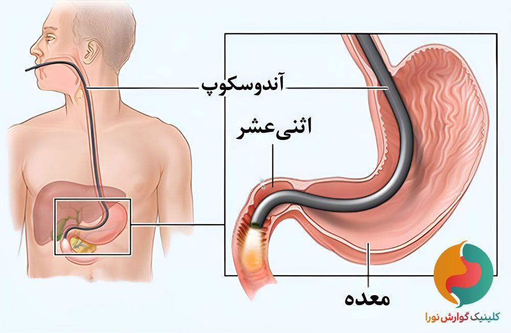تشخیص مشکلات گوارشی با آندوسکوپی