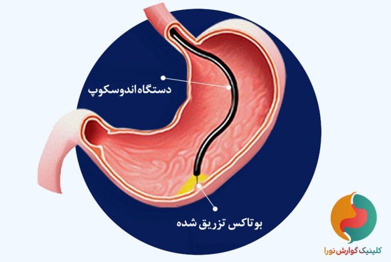 بوتاکس معده و مراقبت‌های بعد از آن