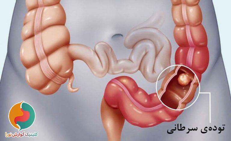 علائم سرطان روده