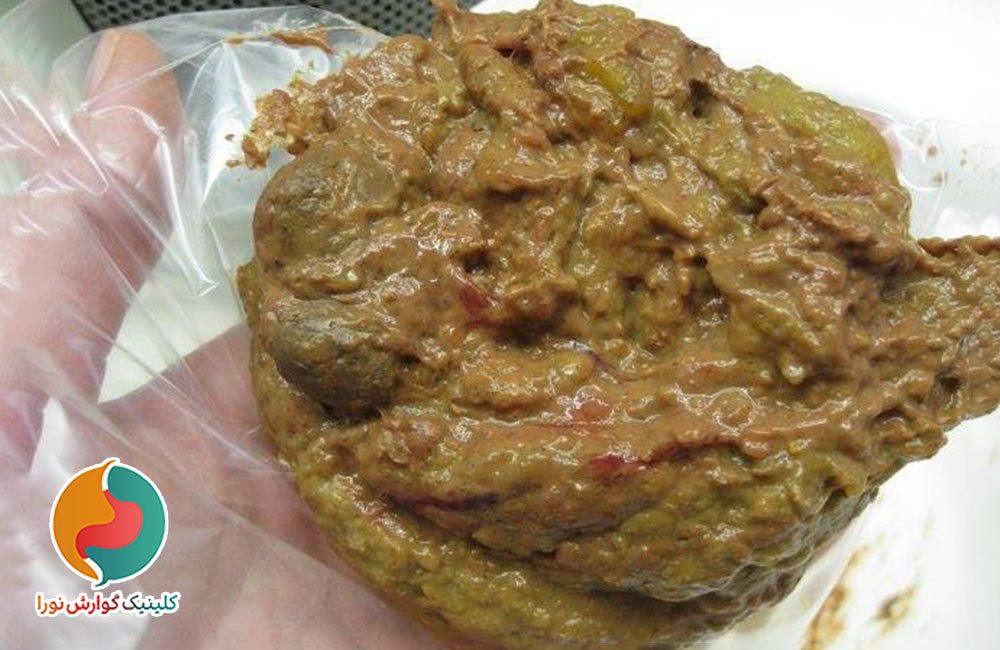 خون در مدفوع و خونریزی مقعدی