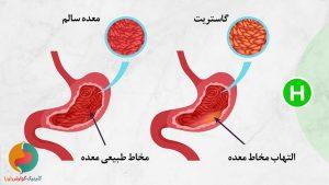 التهاب معده