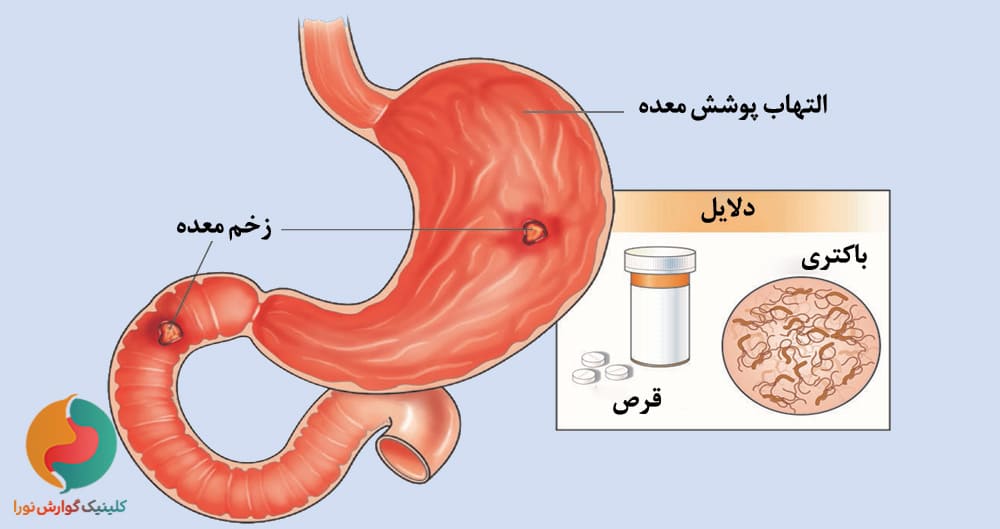 عدم درمان باکتری معده