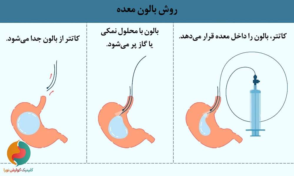 روش بالون معده