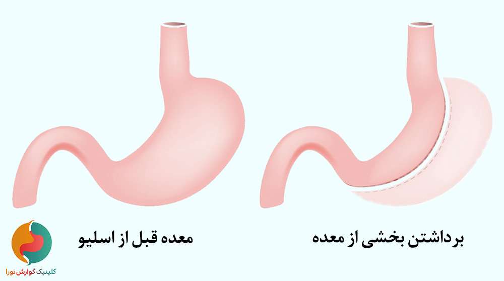 اسلیو معده