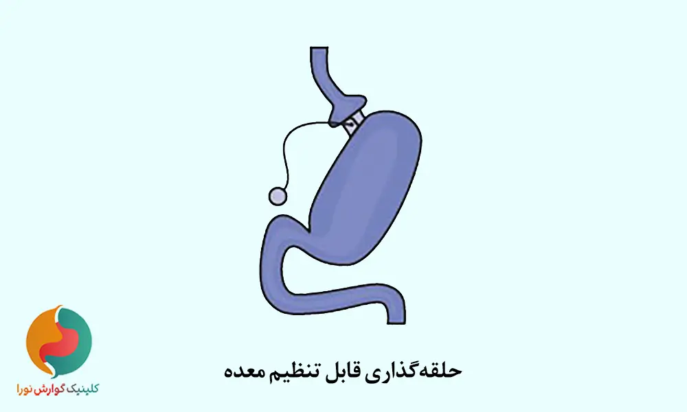 باندینگ معده