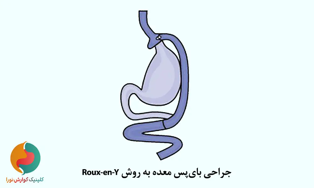 بای‌پس معده