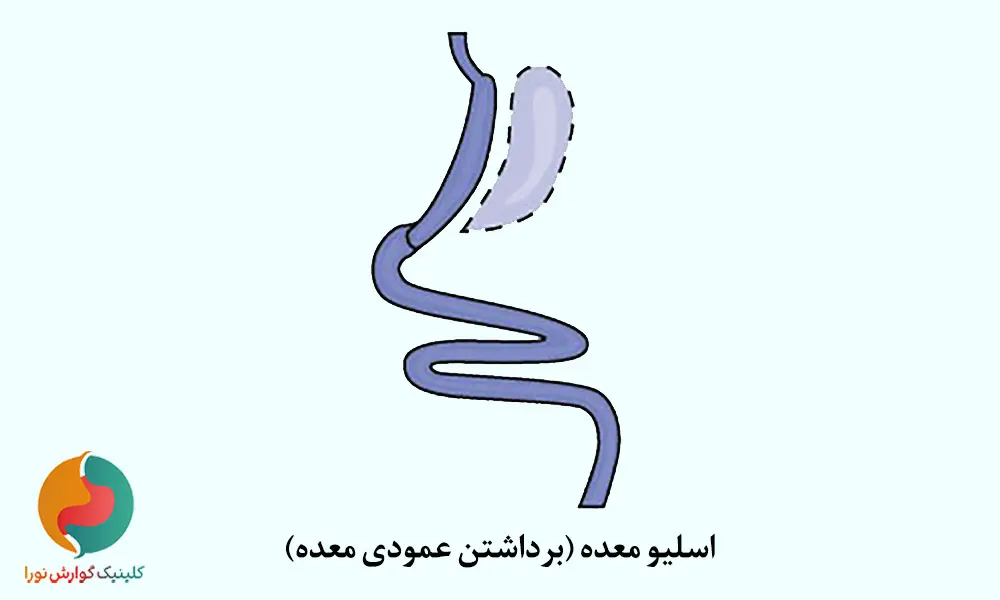 اسلیو معده