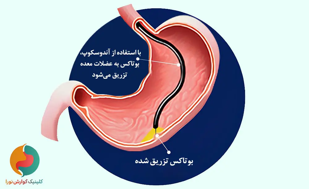 تزریق بوتاکس معده