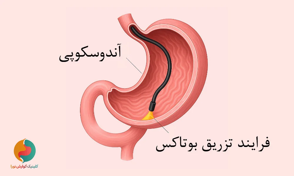 فرایند تزریق بوتاکس