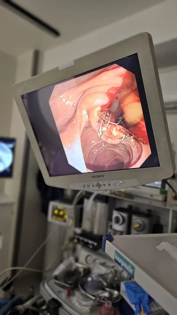 ercp