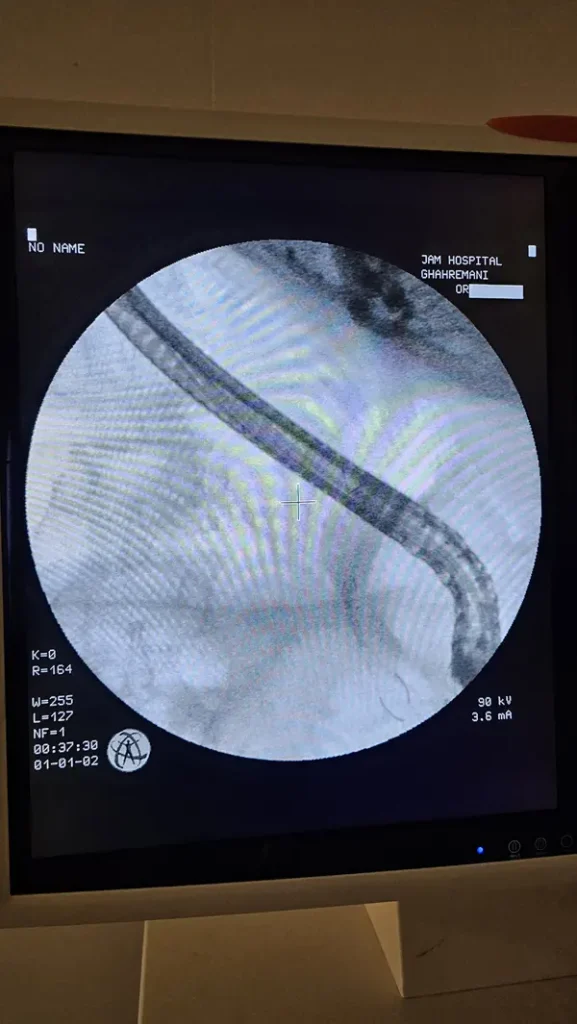 ercp
