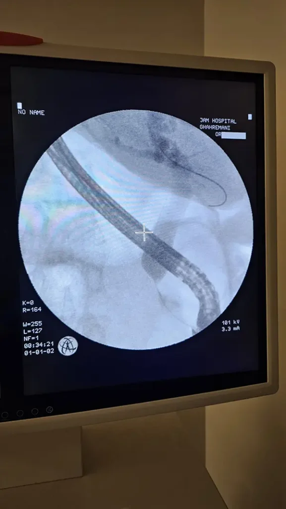 ercp